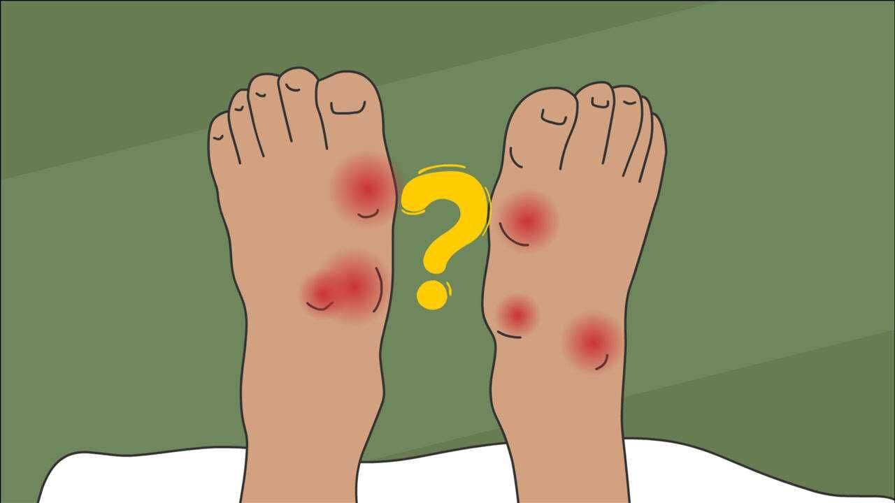 急性痛风发作双脚肿胀疼痛敷脚时牢记1件事双脚会感谢你