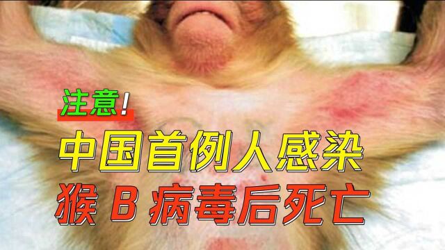 中国首例!人感染猴B病毒后死亡病例!