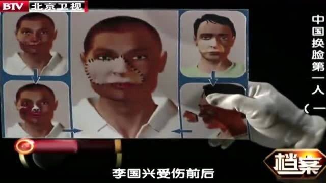 中国首例换脸人手术模拟图,面部被黑熊撕扯,手术难度惊人