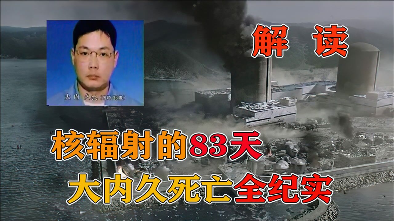 核辐射感染者大内久被“强行续命”，专家用83天记录下了全过程_高清