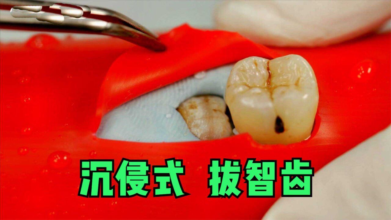 第1视角拔智齿，先划开牙龈，然后用电钻裂牙，看着太疼了！_腾讯视频