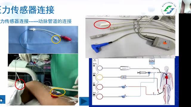 PiCCO穿刺置管、连接和数据获取