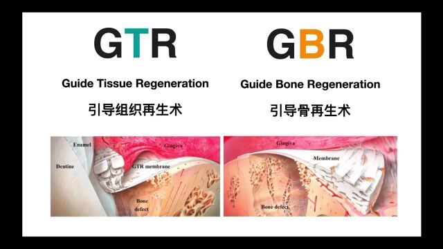 仕诺康线上直播课:GTR vs GBR——引导再生中的是与非(一)片段(1)