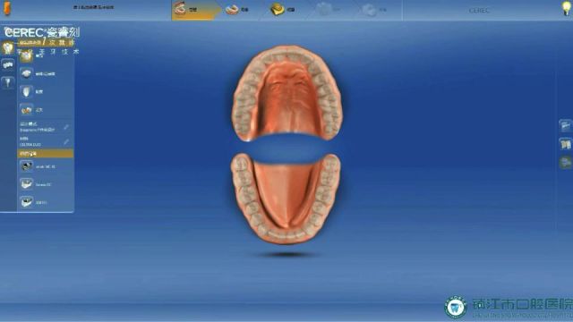 CEREC计算机辅助设计