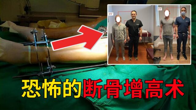 断骨增高是什么?小伙花16万请人打断自己双腿,真能长高7厘米?