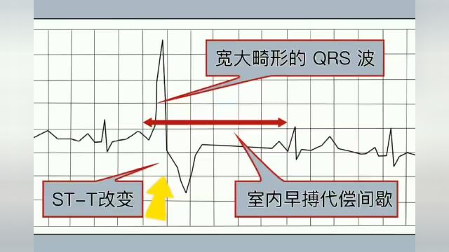 室性早搏心电图特点