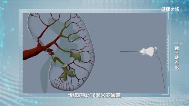 肾结石有多“磨人”?该怎么去除?专业医生来科普|健康之路