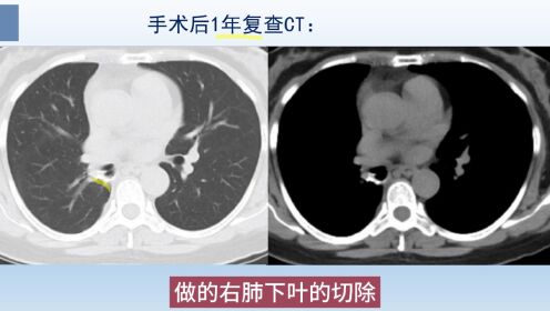 肺炎型肺癌CT征象分析，这种肺癌像肺炎，但抗生素治疗无效