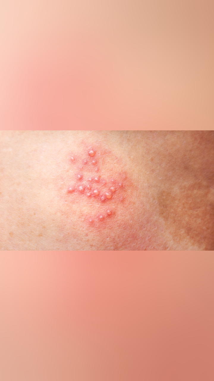 女性患有生殖器疱疹会有哪些麻烦