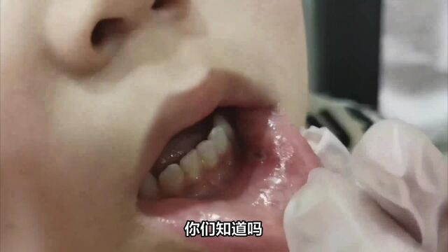 白塞氏长春哪家医院治得好一些?吉林东方口腔黏膜中心