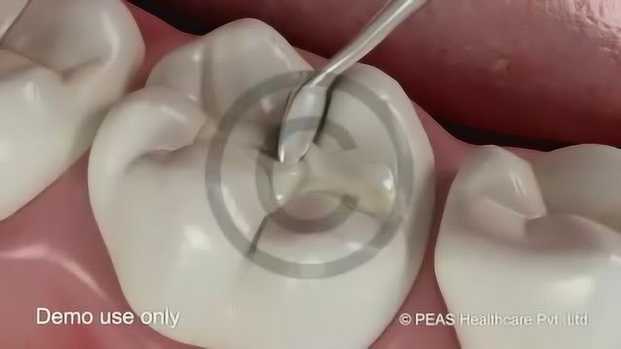 玻璃离子聚合物补牙过程牙齿窝沟龋坏就是这样修复的