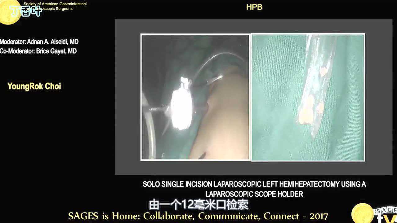 腹腔镜胰十二指肠空肠吻合术缝合技术_高清