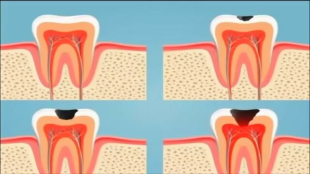 蛀牙龋坏的蔓延过程,从浅龋到深龋!
