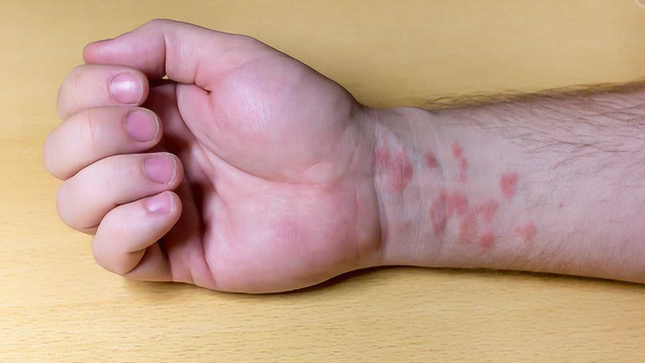 患上梅毒有哪些前期征兆?医生说出了3个明显特征,希望你不要错过!