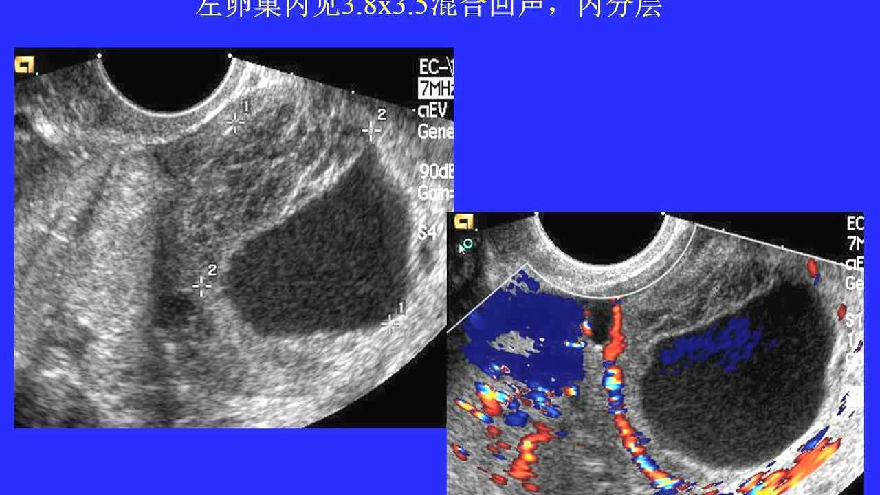 黄体囊肿的超声图片图片