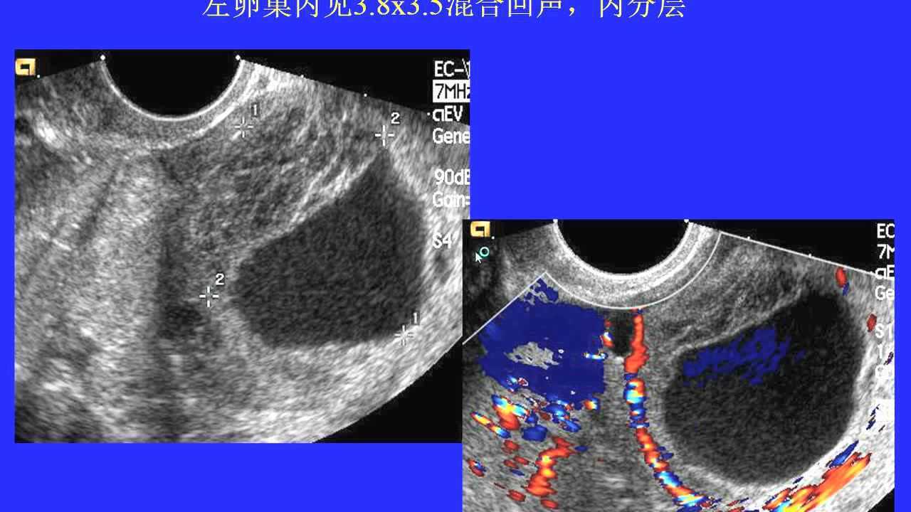 黄体囊肿的各种声像图表现