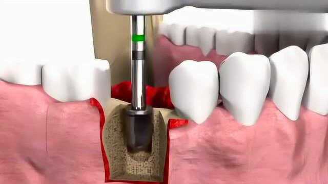 种植牙全过程,大家看看吧!