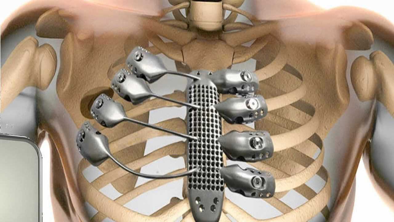 3d演示把人体骨头全换成钛合金,仿佛看到下一个金刚狼