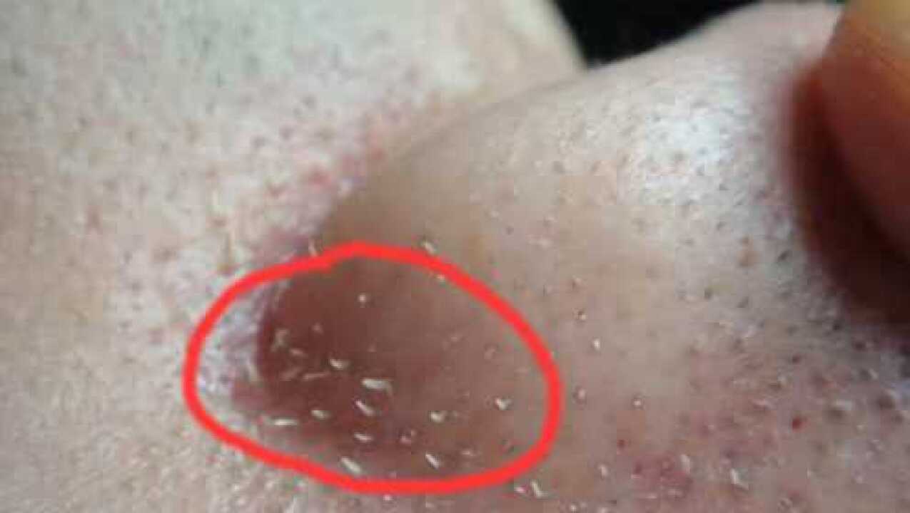 鼻子上挤出来的白色东西是什么真的是螨虫的粪便吗可算知道了