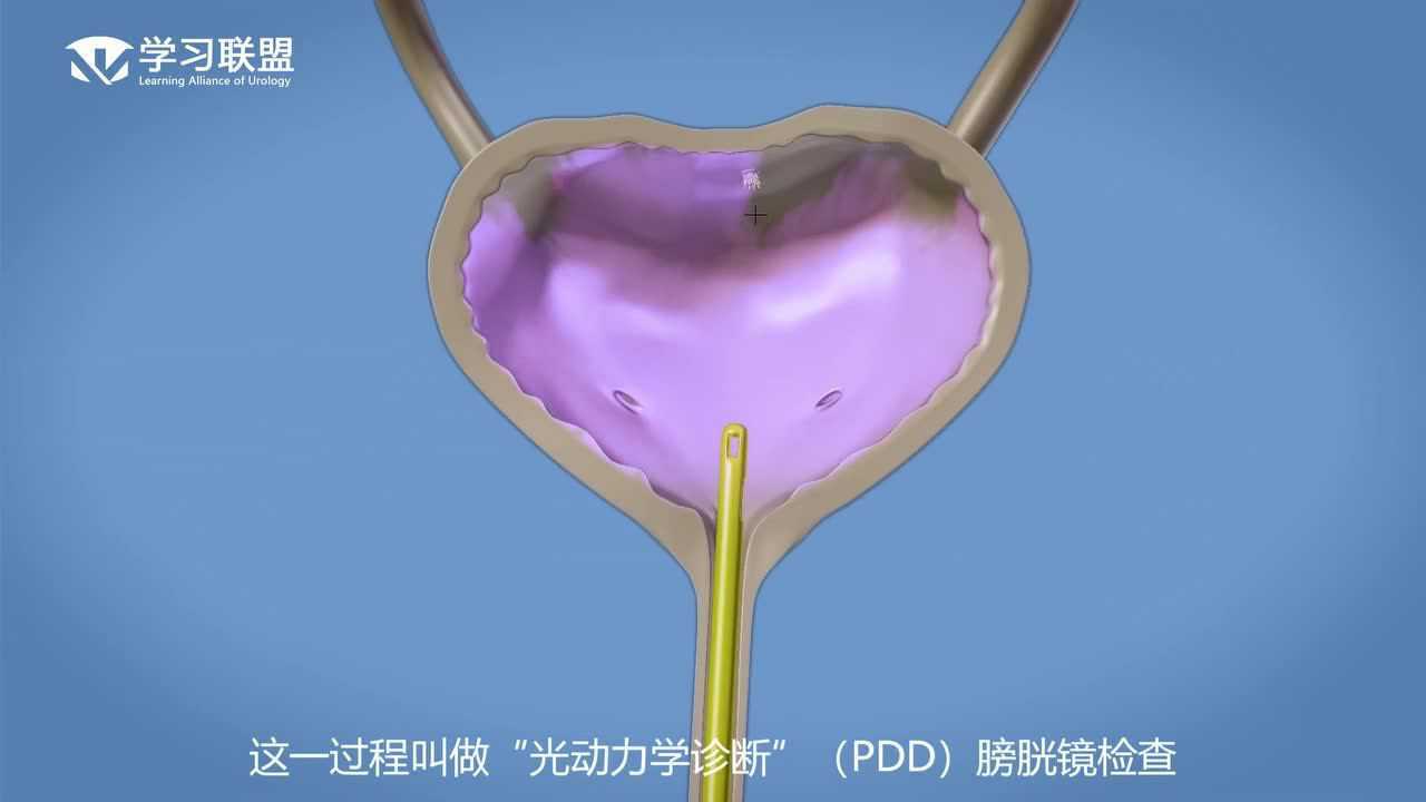 经尿道膀胱肿瘤电切术(turbt)-eau_腾讯视频