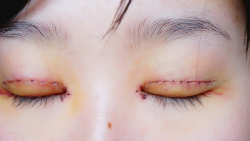 那些曾经割了双眼皮的女生，10年后会变成什么样？