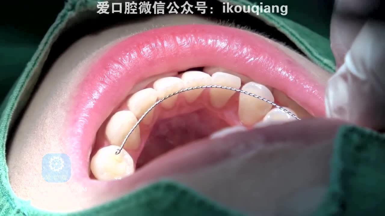 舌侧保持器粘结实拍_高清1080P在线观看平台_腾讯视频