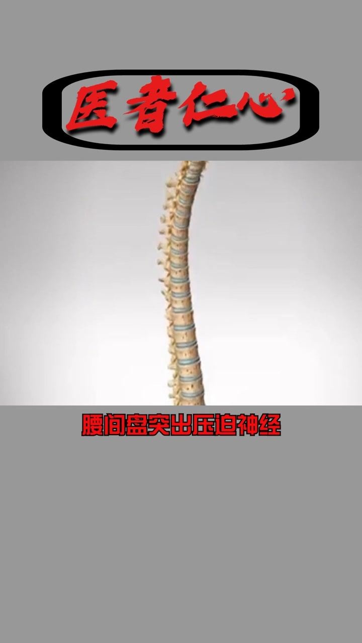 腰间盘突出压迫神经!