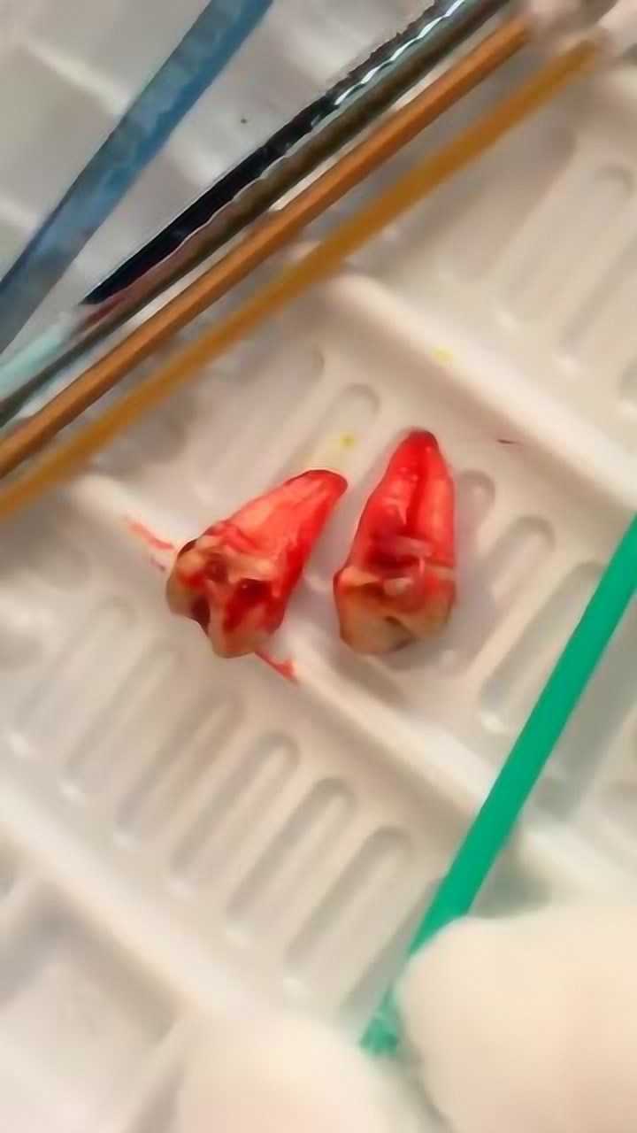 这样拔牙齿,不知道疼不疼