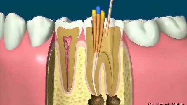 根管治疗及牙冠的修复大揭秘,看着怎么和闹着玩一样?
