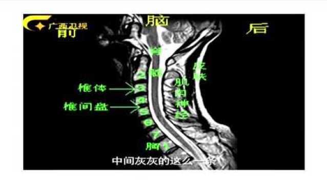 脖子酸痛就叫颈椎病吗?专家一张图告诉你,不懂快来看看!