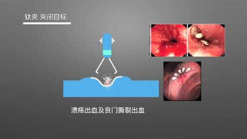 钛夹知识学习_高清1080P在线观看平台_腾讯视频