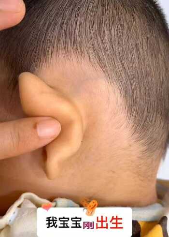 新生儿耳朵紧贴头壁如何护理,你学会了吗?