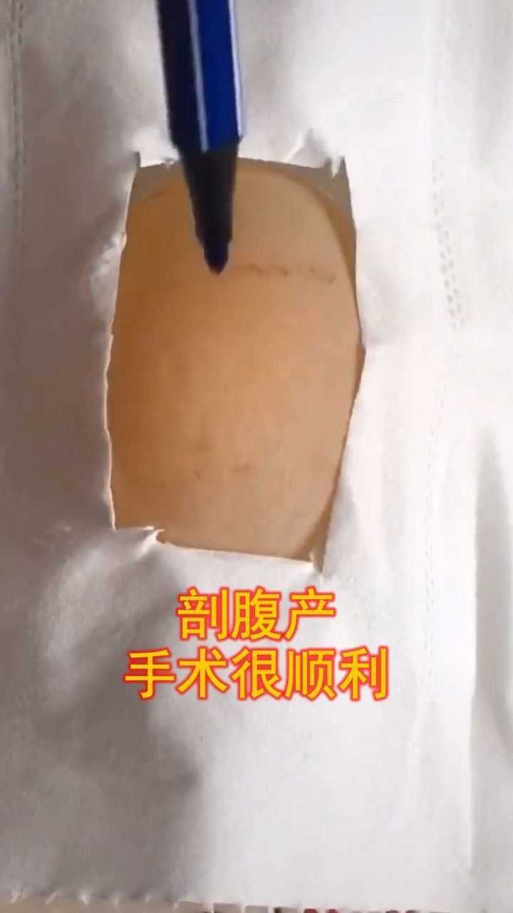 剖腹产，手术很顺利！_高清