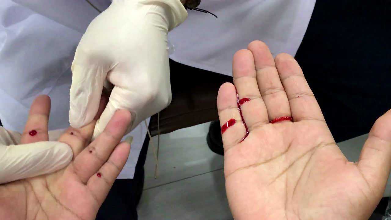 疳积消瘦四缝刺血