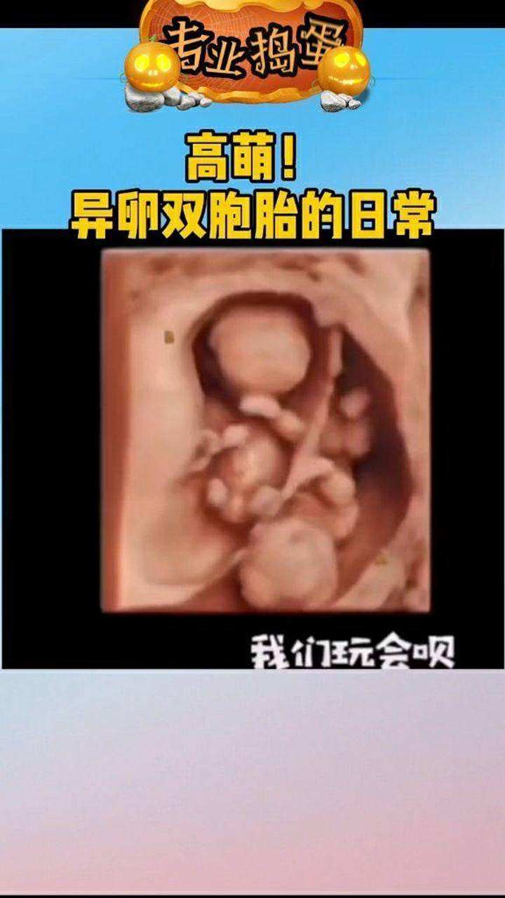 震撼异卵双胞胎在妈妈肚子里这也太热闹了吧