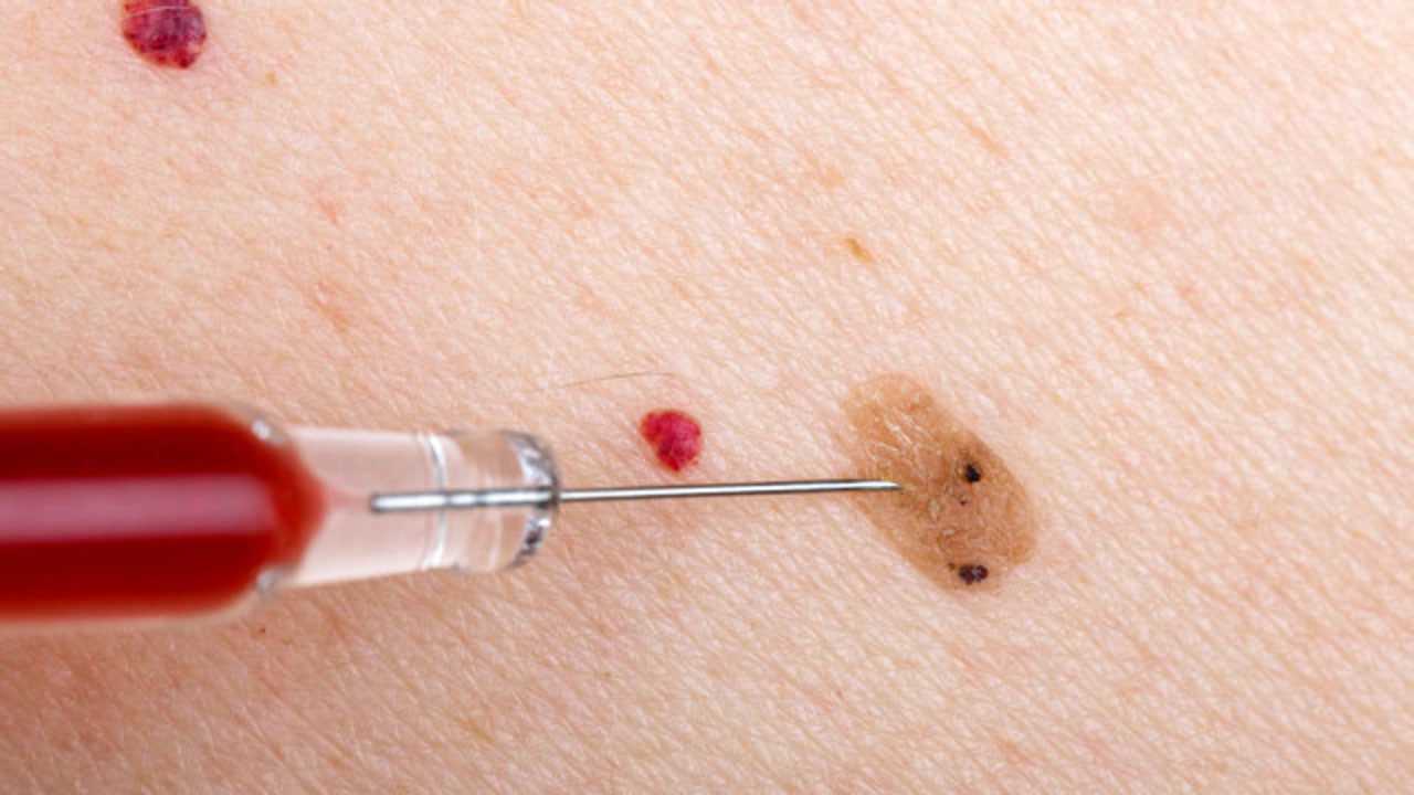 白血病又称"血癌",如何判断皮肤出血点?