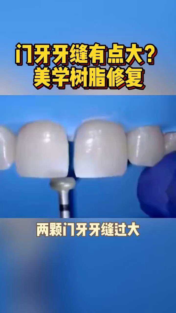 门牙牙缝树脂补牙利弊,大门牙树脂补牙缝图片,门牙补牙好还是贴面好(第15页)_大山谷图库