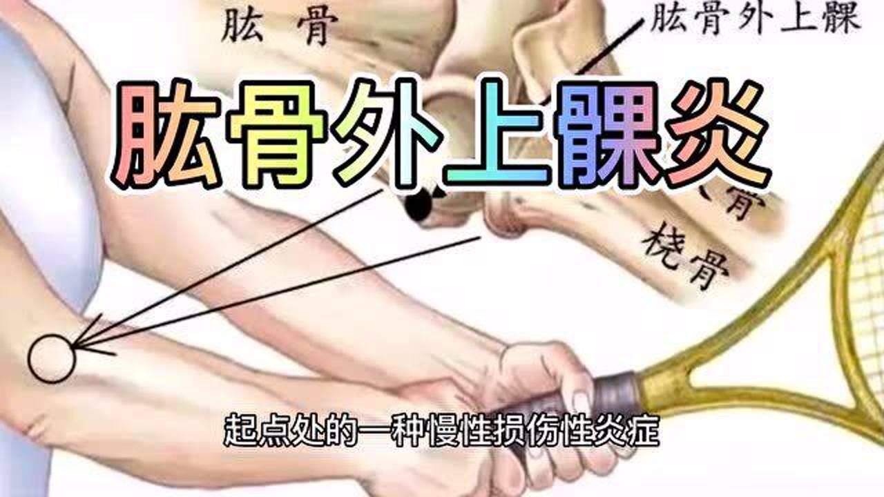 网球肘是什么医生说只要记住这一点疼痛不再困扰你