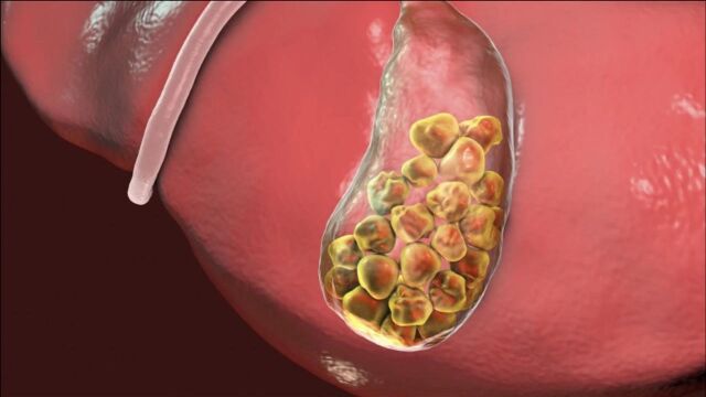 得了胆囊结石的人,身上的这4个表现会比较明显,该察觉了
