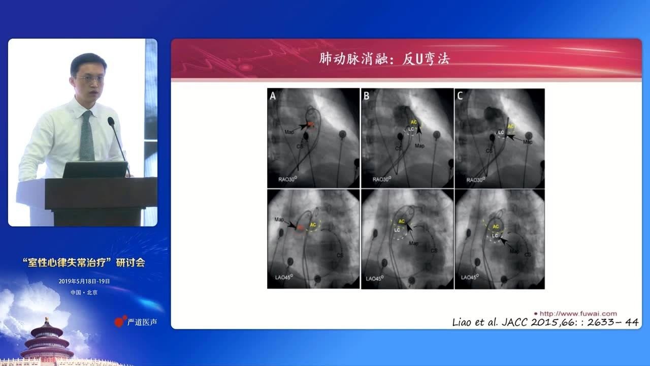 唐闽 肺动脉窦区域起源室性心律失常的心电特点、消融方法及其解剖学特征_高清1080P在线观看平台_腾讯视频