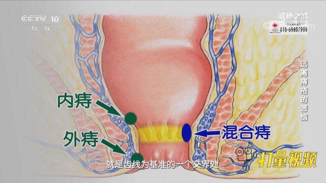 痔疮也分类型!专家介绍3种类型,来看看你是哪种