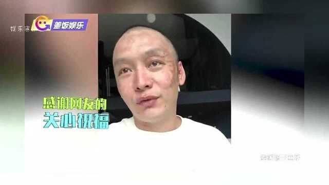 被烧伤歌手徐真真晒出院视频,脸部仍有大面积伤疤,称想尽快复出