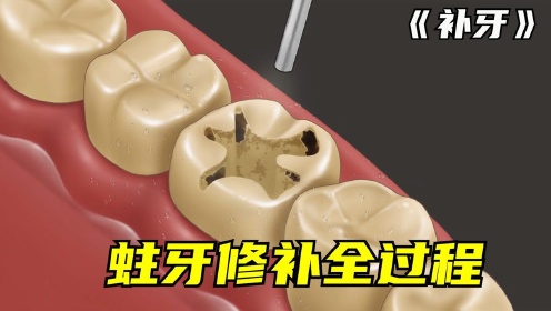牙医补牙全过程，看完牙齿隐隐作痛，请戴上耳机观看