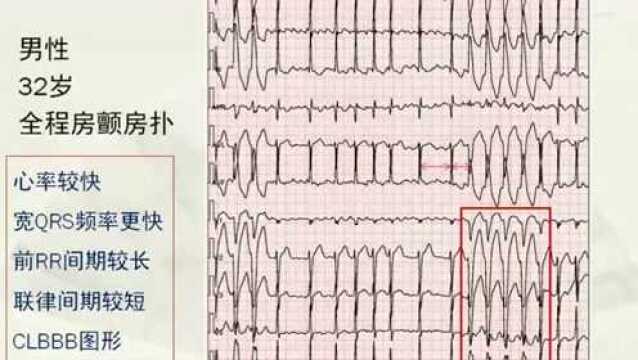 2022.01.06【心电讲座】洪丽:房颤中的宽QRS辨析