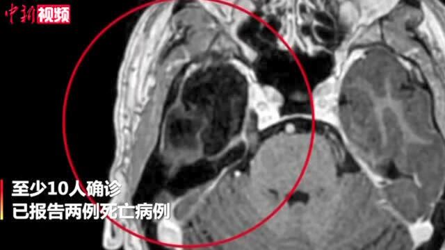 澳大利亚4个州出现乙脑病毒传播至少10人确诊