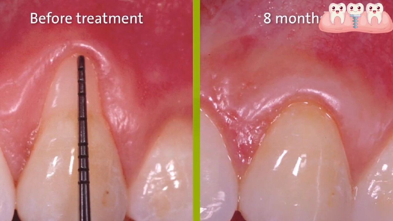 牙根都露出來了,還能恢復嗎?使用生長因子治療牙齦萎縮.