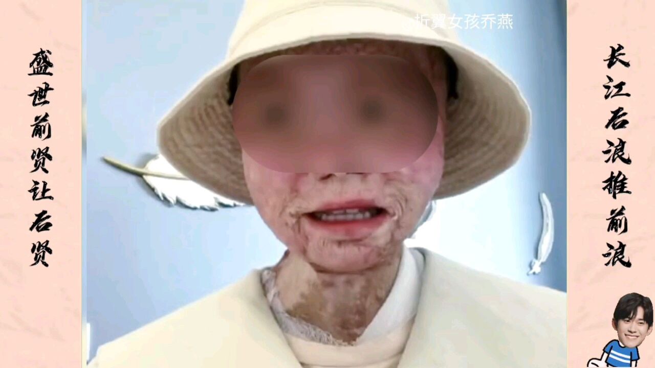 四川乐山24岁折翼女孩乔燕,烧伤截肢928天重生,忍不住破防了