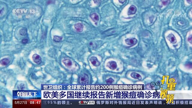 多国继续报告新增猴痘确诊病例,意大利排除猴痘成为流行病风险