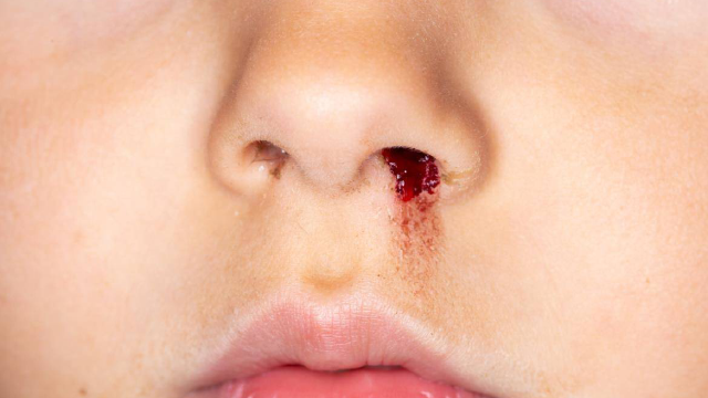 孩子经常流鼻血会是白血病吗?中医轻松教你区分