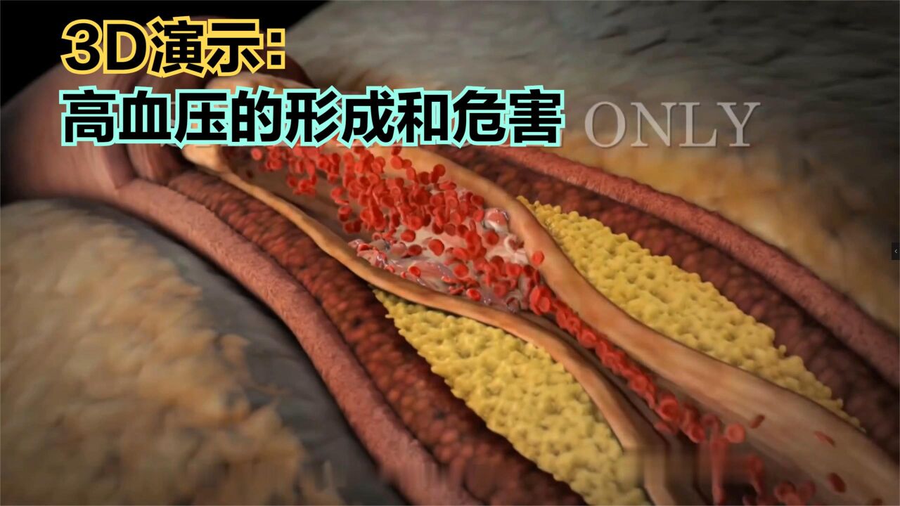 人体3D科普_3D演示:高血压的形成和危害原理,你身边有高血压的人吗?_高清1080P在线观看平台_腾讯视频